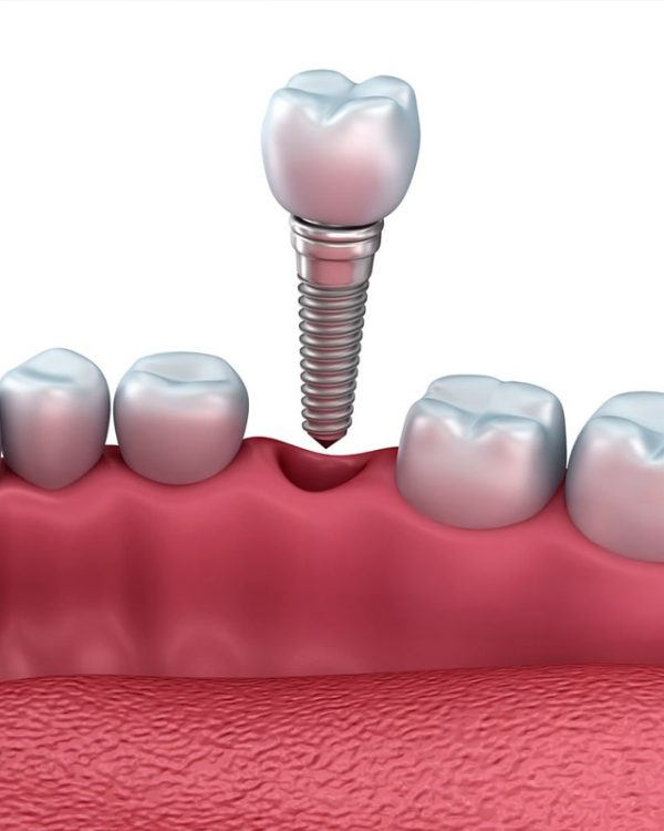 extracciondientes2